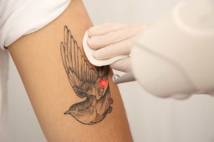 Tattoo Removal Day