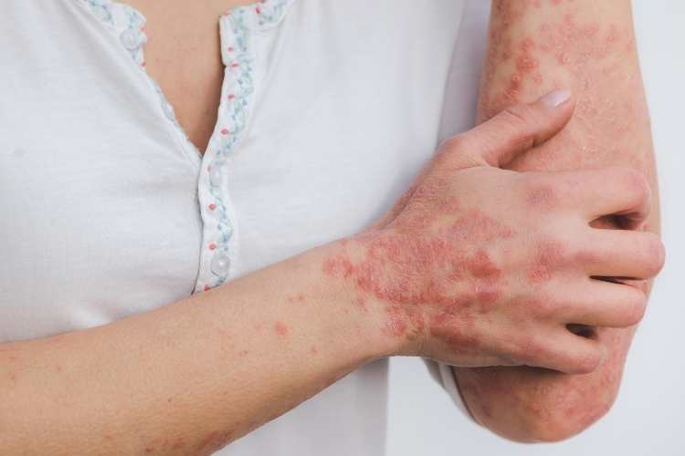 World Psoriasis Day