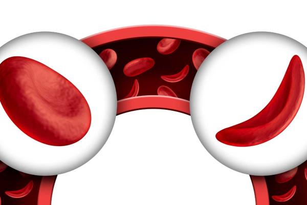 World Sickle Cell Day (WSCD) 