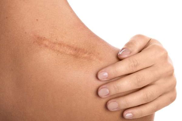 Scar Appreciation Day