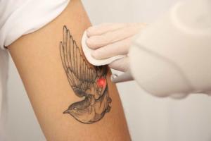Tattoo Removal Day